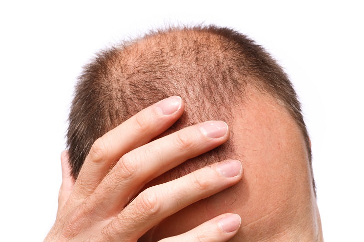 The Complete Cure for Baldness is on the Horizon!