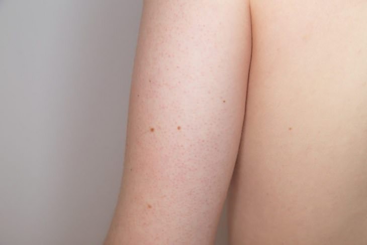 Got Tiny Red Spots on Your Arms? You Need to Read This...