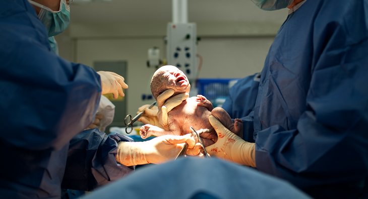A Link Found Between Cesarean And Child Obesity...