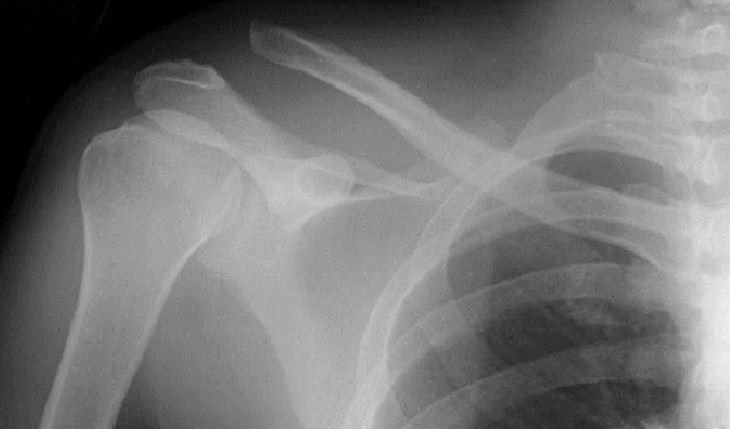 A Comprehensive Guide to Treating Shoulder Pain at Home