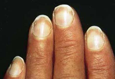 Diagnose Health Issues by Looking at Your Nails