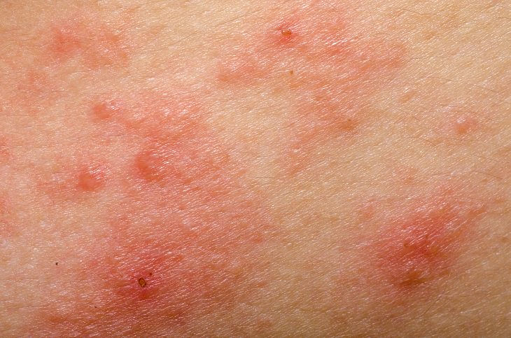 7 Types of Rashes You Must Be Able to Identify