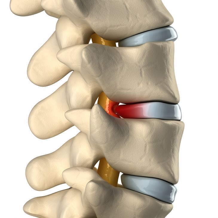 Learn to Identify and Treat a Herniated Disc!