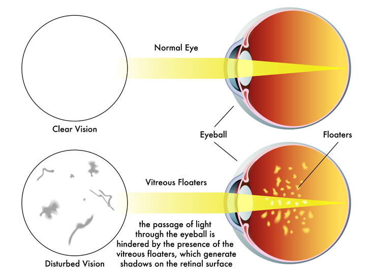 This New Treatment Looks Set to End Annoying Eye Floaters