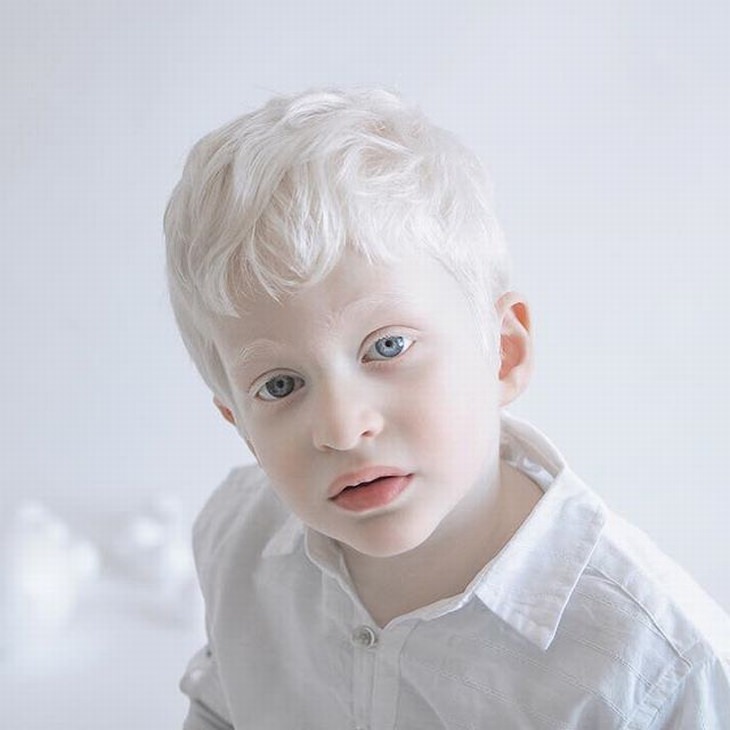 albino-portraits