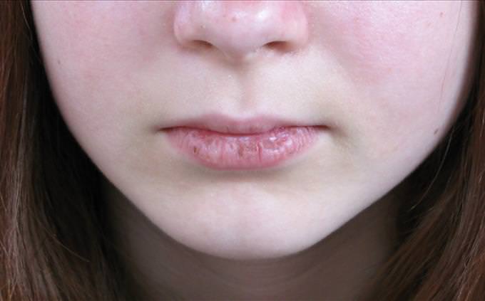 girl with cracked lips