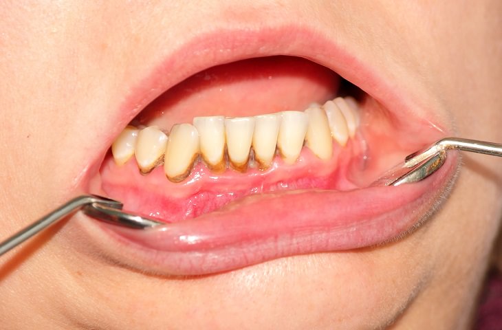 6 Daily Mistakes that Damage Your Teeth