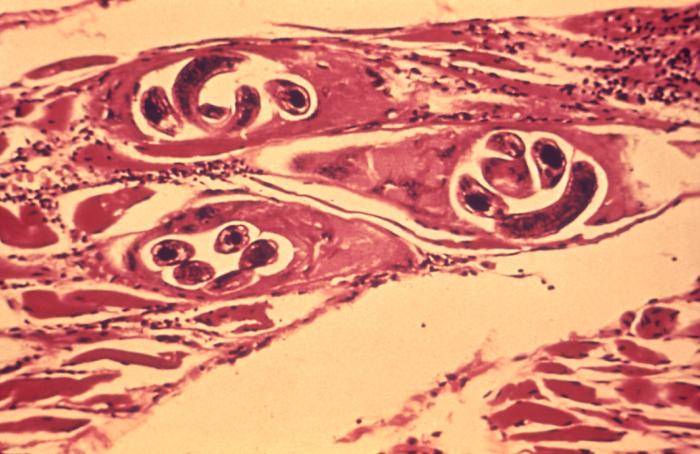 The Enemy Within: 8 Common Human Parasites