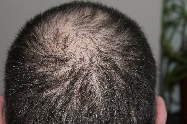 balding