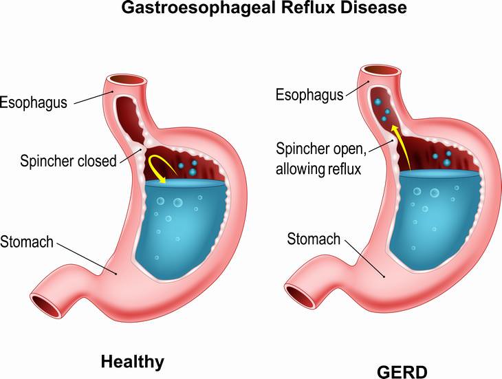 acid reflux