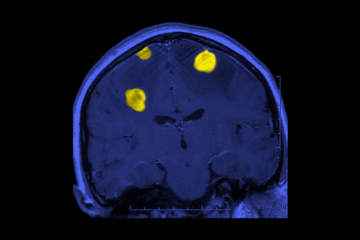 Brain Tumor