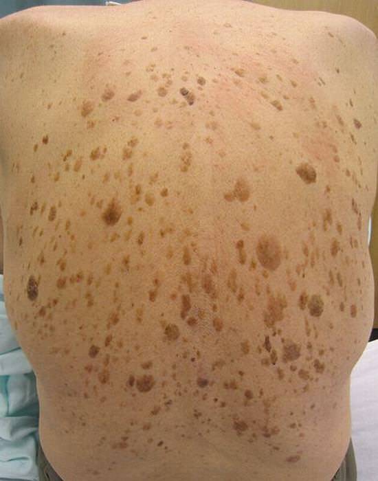 skin spots