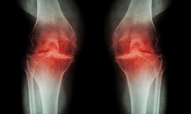 If Your Joints Are Bothering You, You Need to Read This