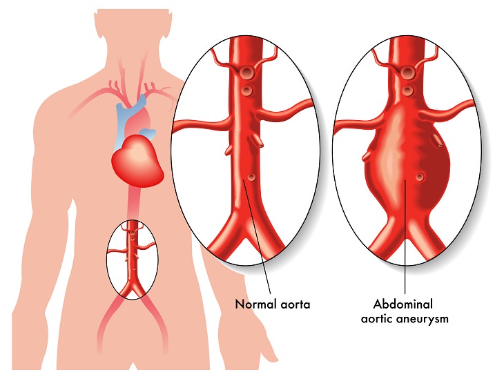 Aortic Aneurysm