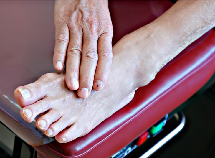 Diabetic Neuropathy