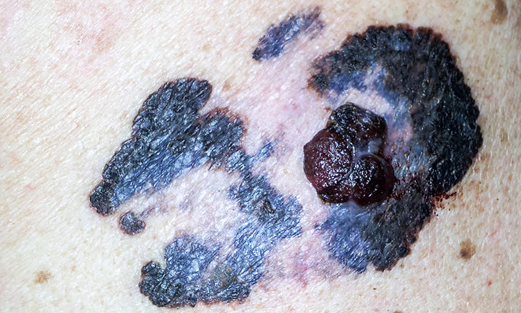 skin-cancer