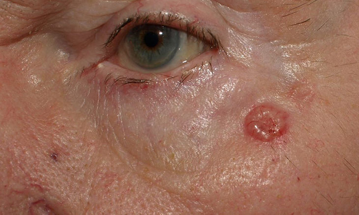 skin-cancer