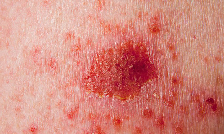 skin-cancer