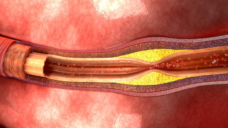 Cholesterol and Sleep Apnea