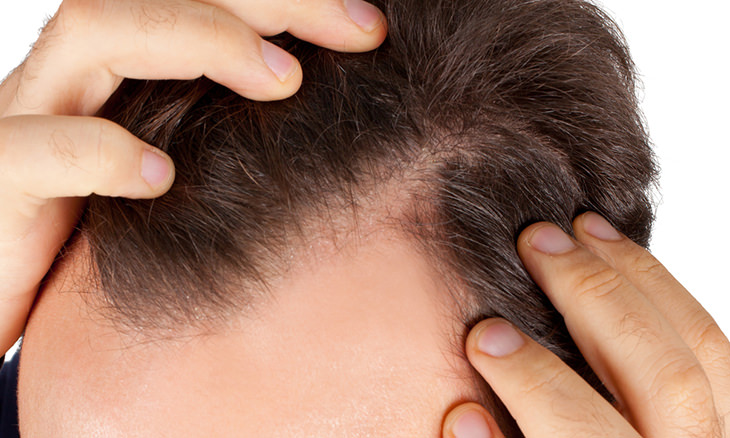Natural Remedies to Fight Hair Loss
