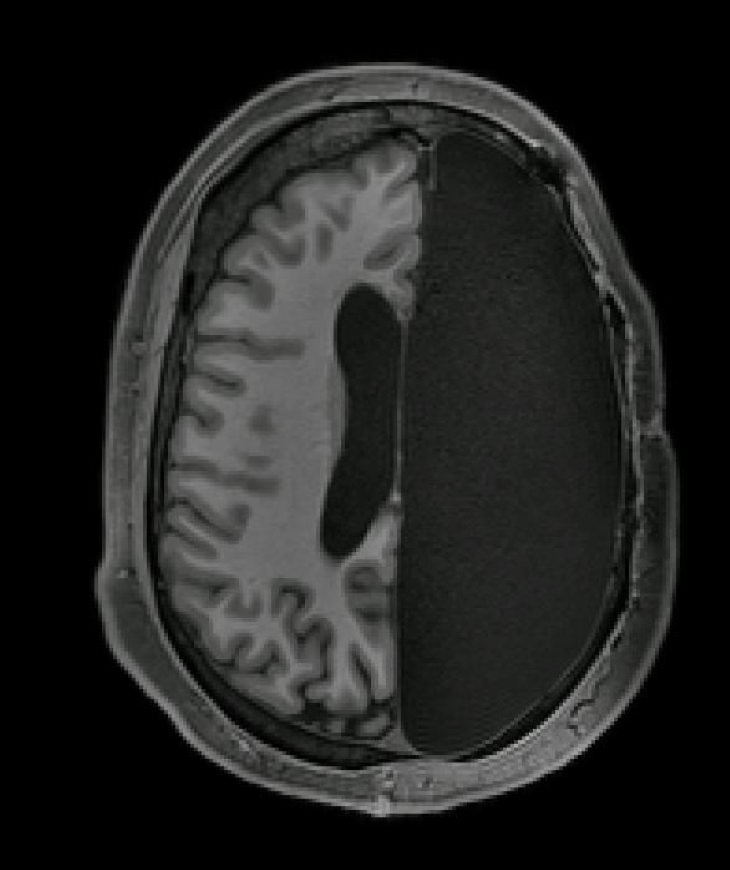 neuroplasticity hemispherectomy