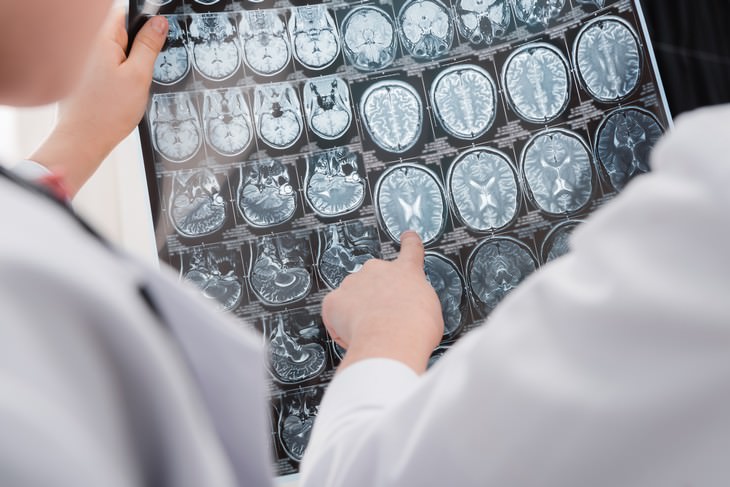 depression myths doctor pointing at brain scan