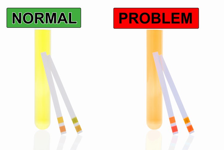 symptoms of liver disease urine color