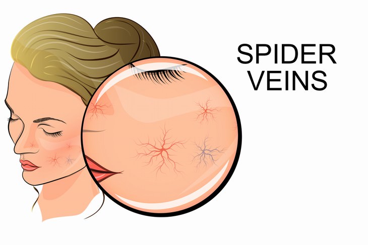 symptoms of liver disease spider veins