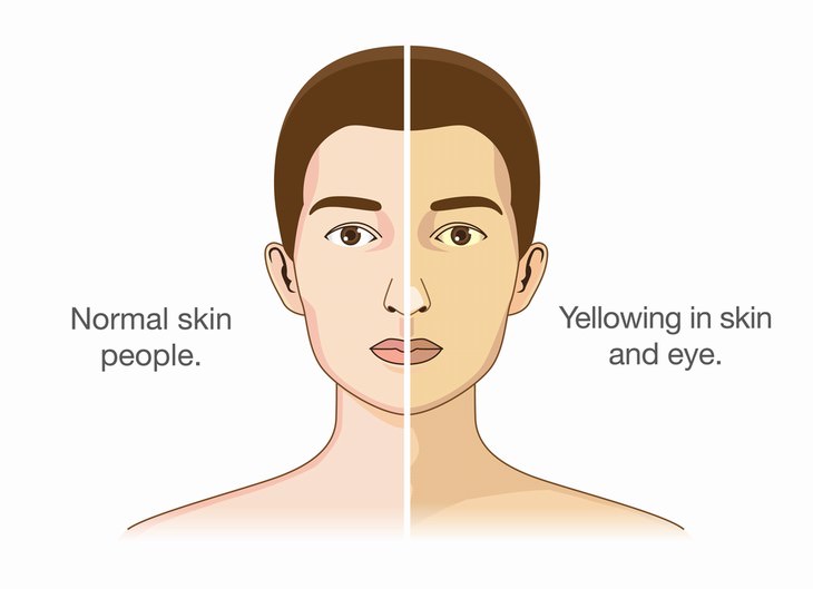 symptoms of liver disease jaundice