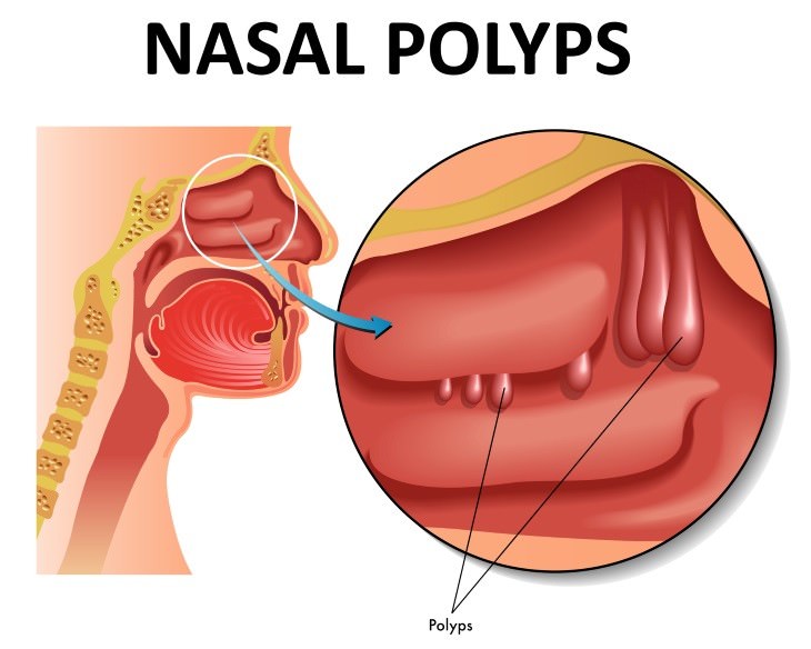 Chronic Sinusitis Causes nasal polyps