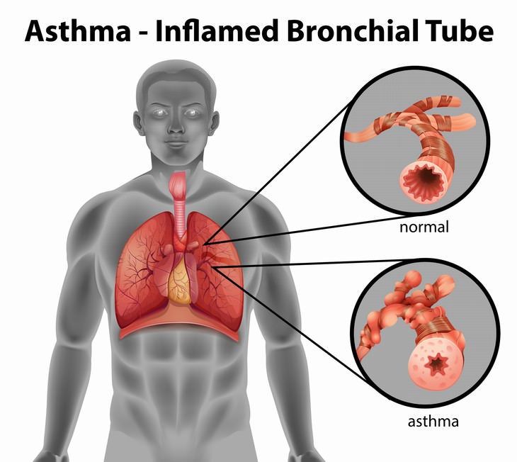 Chronic Sinusitis Causes