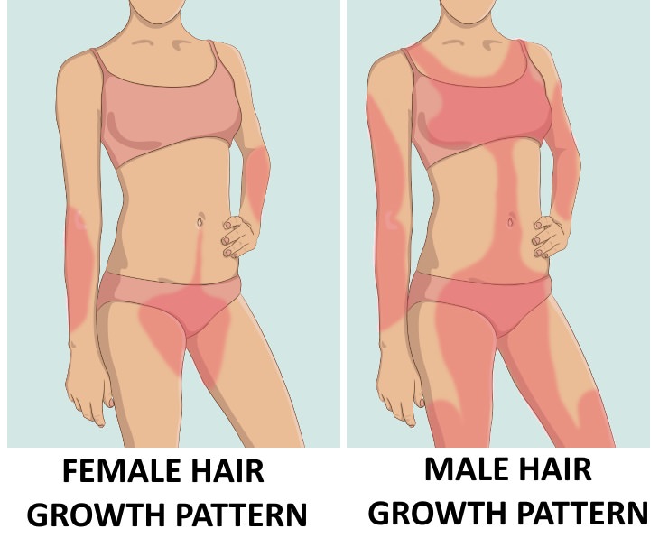 excess hair growth in women body