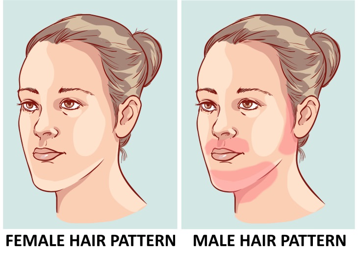 excess hair growth in women face