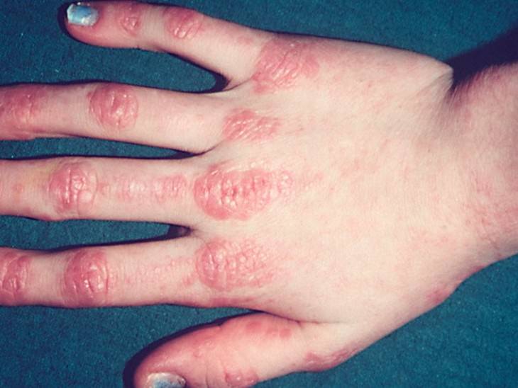 Skin Symptoms Of Other Diseases dermatomyositis