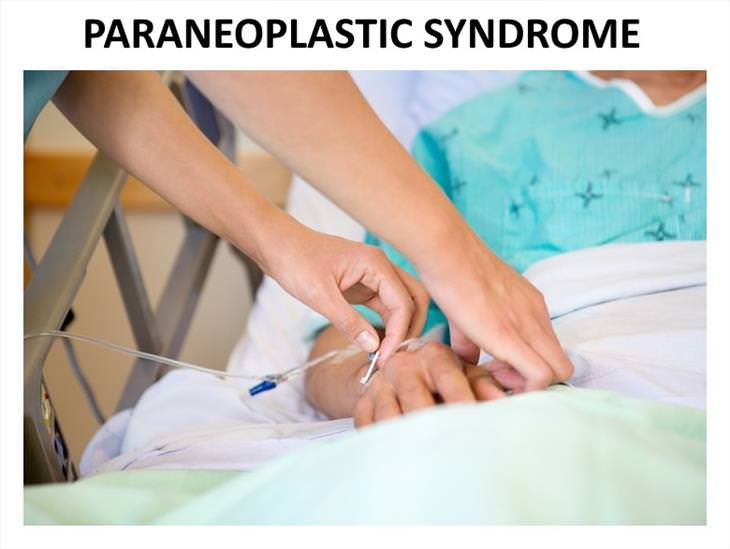 Causes Of Hand Numbness Paraneoplastic Syndromes