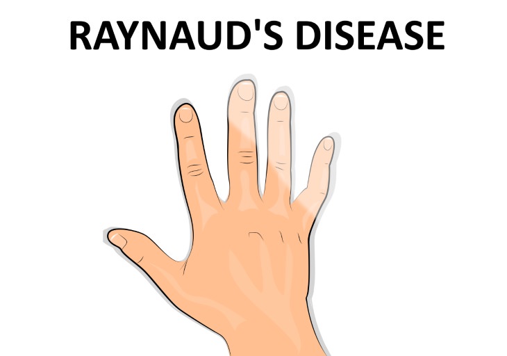 Causes Of Hand Numbness Raynaud’s disease