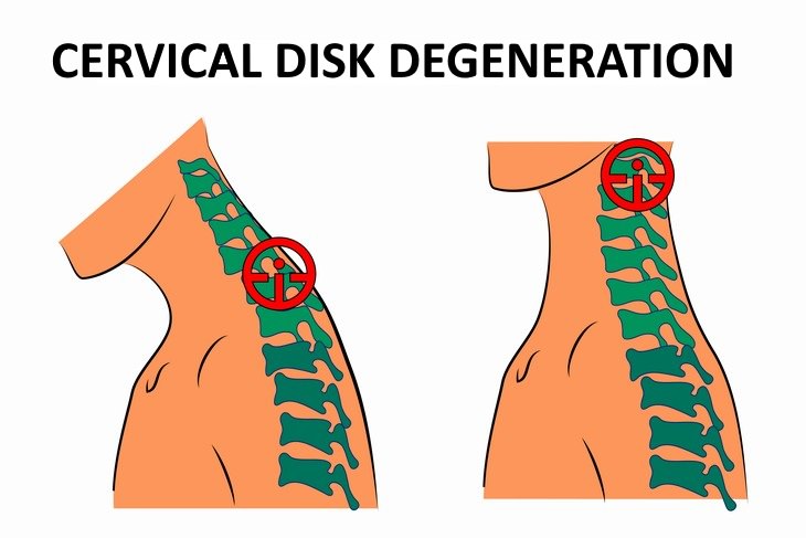 Causes Of Hand Numbness Cervical Disk Degeneration