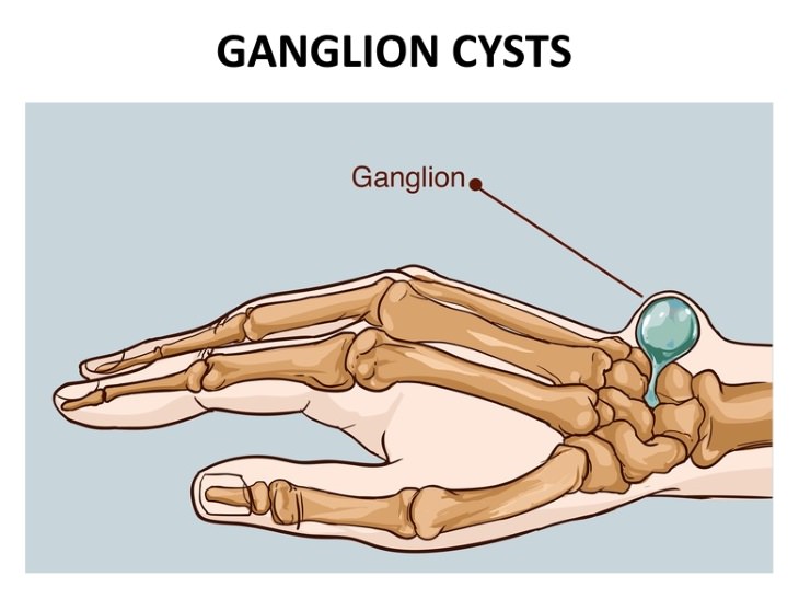 Causes Of Hand Numbness Ganglion Cysts