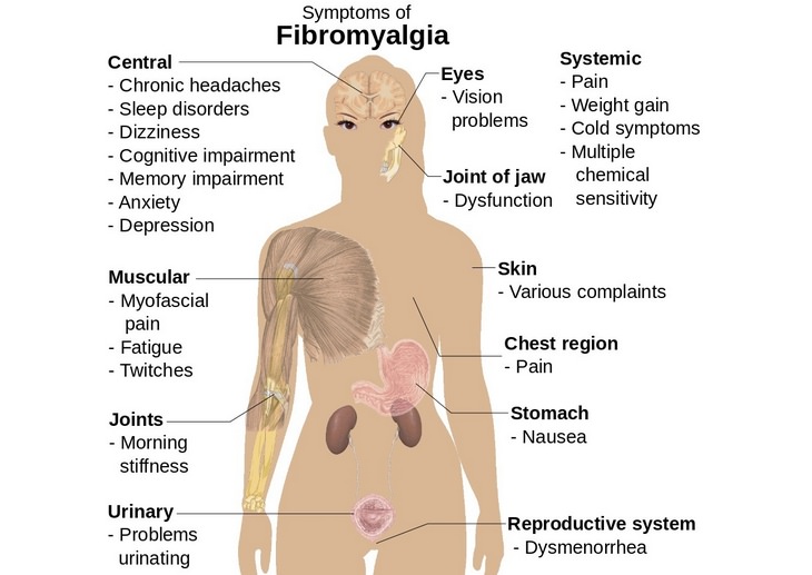 Chronic back pain: fibromyalgia