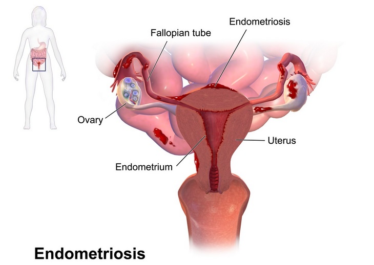 Chronic back pain: endometriosis