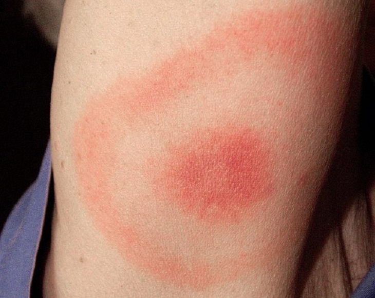 Women's health: Lyme disease