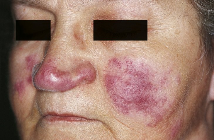 Women's health: lupus