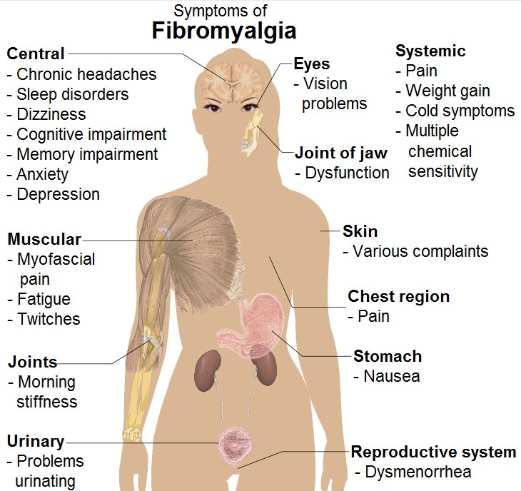 Women's health: fibromyalgia