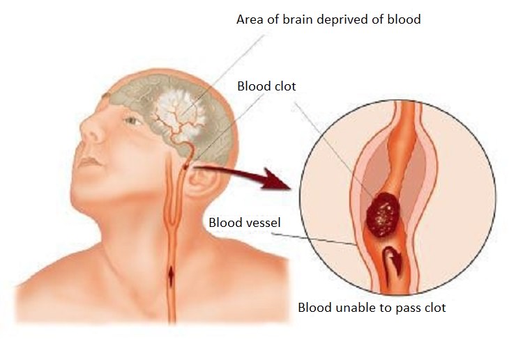 Women's health: stroke