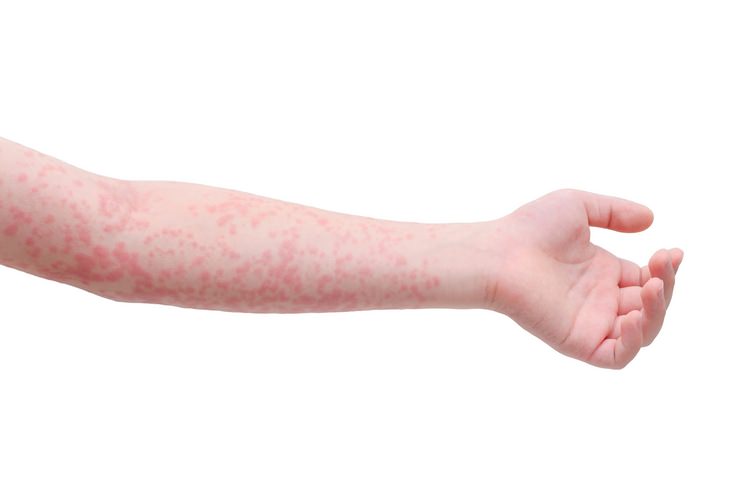 Measles: rash