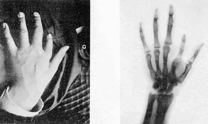 accidental discoveries x-rays