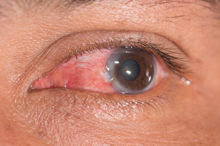 Measles: corneal ulcers