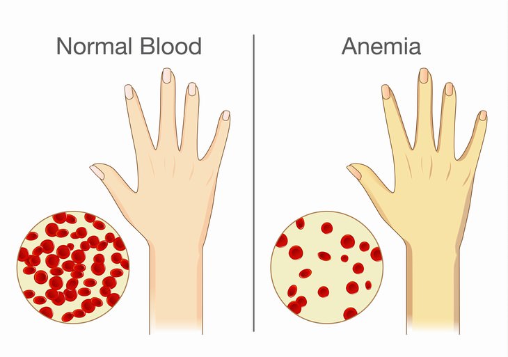 beetroot juice Prevent Anemia