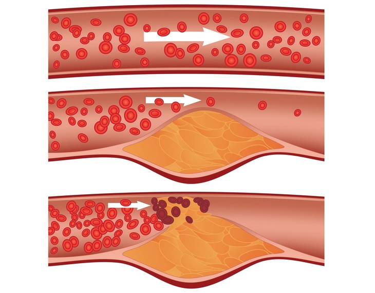 Stroke: blood clot