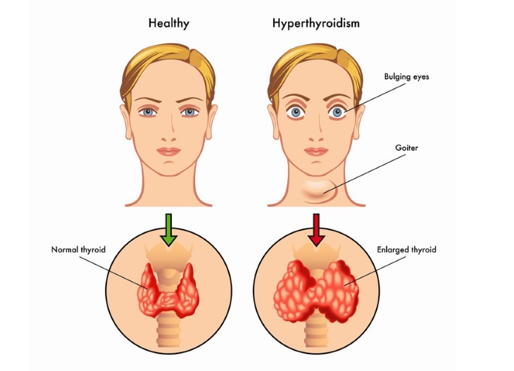 soy guide thyroid